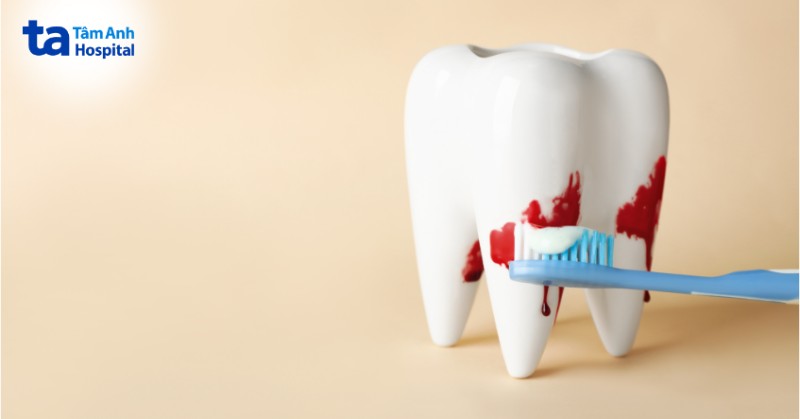 biến chứng nhổ răng khôn, chảy máu kéo dài 