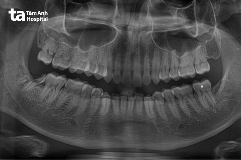 nhổ răng khôn nguy hiểm không, Chấn thương thần kinh