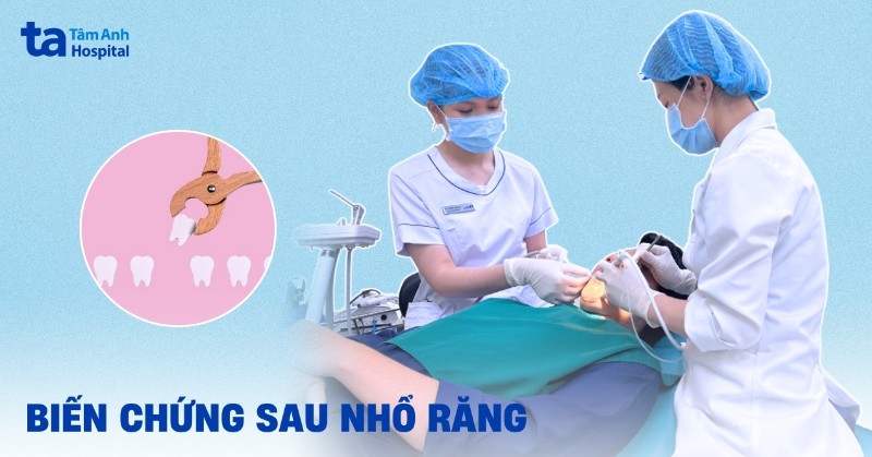 10 biến chứng sau nhổ răng có thể gặp và những điều cần lưu ý