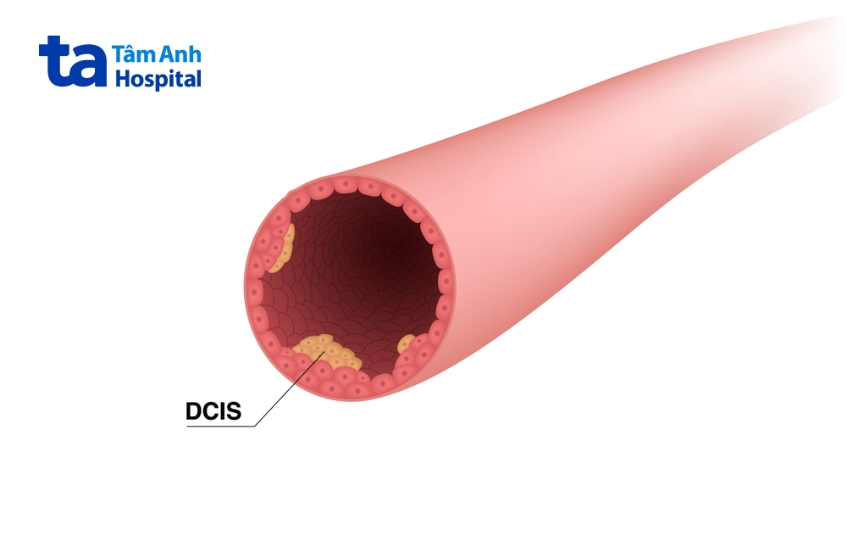 Biên phẫu thuật khép kín