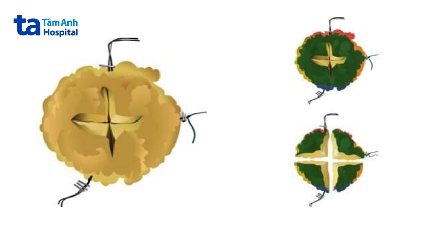 biên phẫu thuật ung thư vú