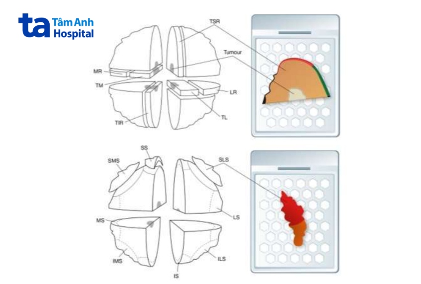 bờ lề phẫu thuật ung thư vú