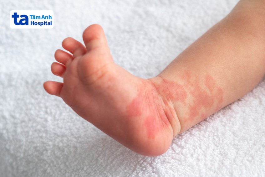 Bướu máu ở chân thường lành tính