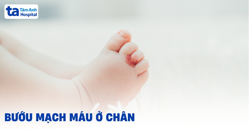 Bướu máu ở chân: Nguyên nhân, triệu chứng và cách điều trị