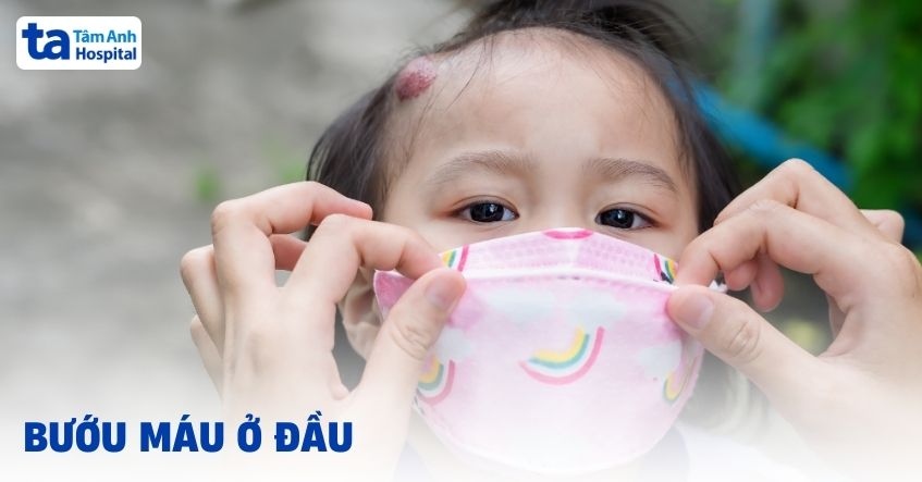 Bướu máu ở đầu: Nguyên nhân, triệu chứng và cách chẩn đoán bệnh