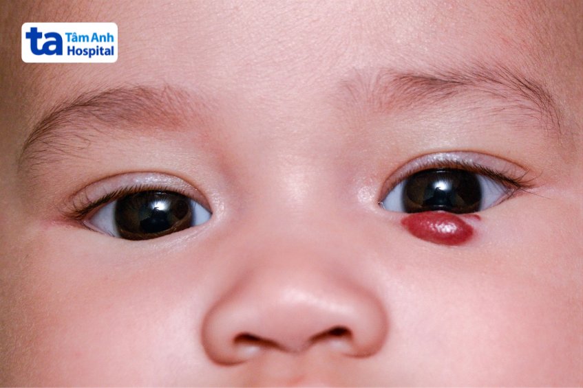 Bướu máu ở những vị trí ảnh hưởng đến thị lực
