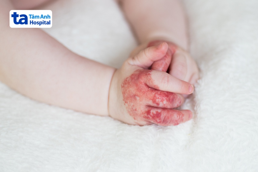 Bướu máu ở tay khi xuất hiện trên da