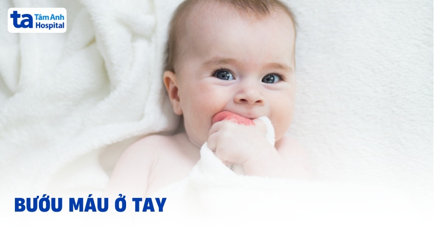 Bướu máu ở tay: Nguyên nhân, triệu chứng và cách điều trị