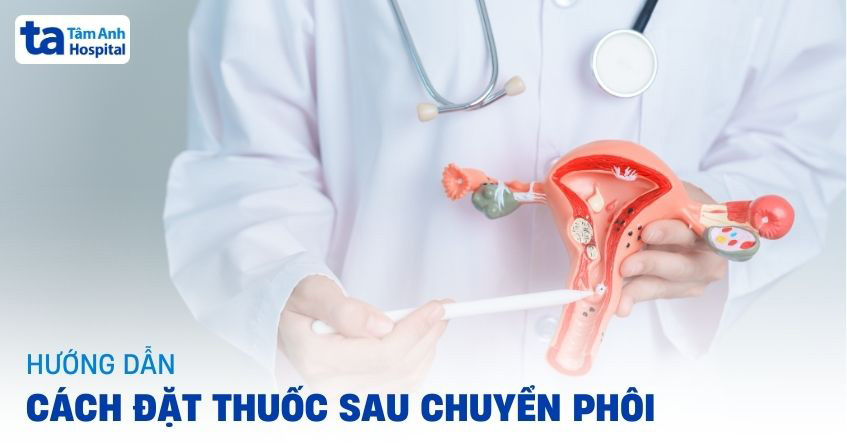 Cách đặt thuốc sau chuyển phôi theo hướng dẫn 6 bước từ [A-Z]