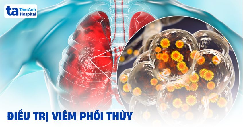2 cách điều trị viêm phổi thùy phổ biến, mang lại hiệu quả cao