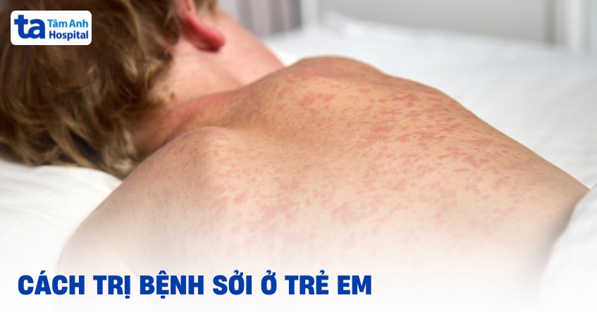 Cách trị bệnh sởi ở trẻ em hiệu quả cha mẹ cần xem và lưu ý kỹ
