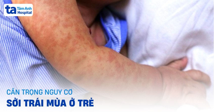 Cẩn trọng nguy cơ sởi trái mùa ở trẻ