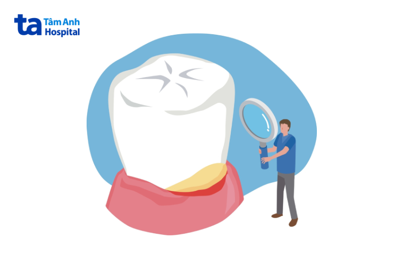 Lưu ý sau khi phẫu thuật nạo túi nha chu