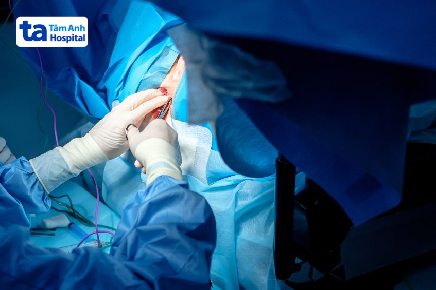 cắt polyp hậu môn có đau không