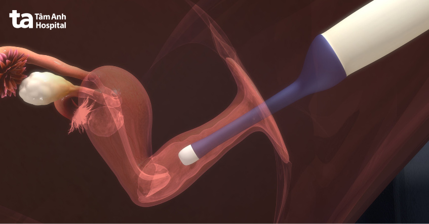 Câu hỏi mỗi lần chọc hút trứng bao nhiêu là bình thường luôn được nhiều chị em quan tâm