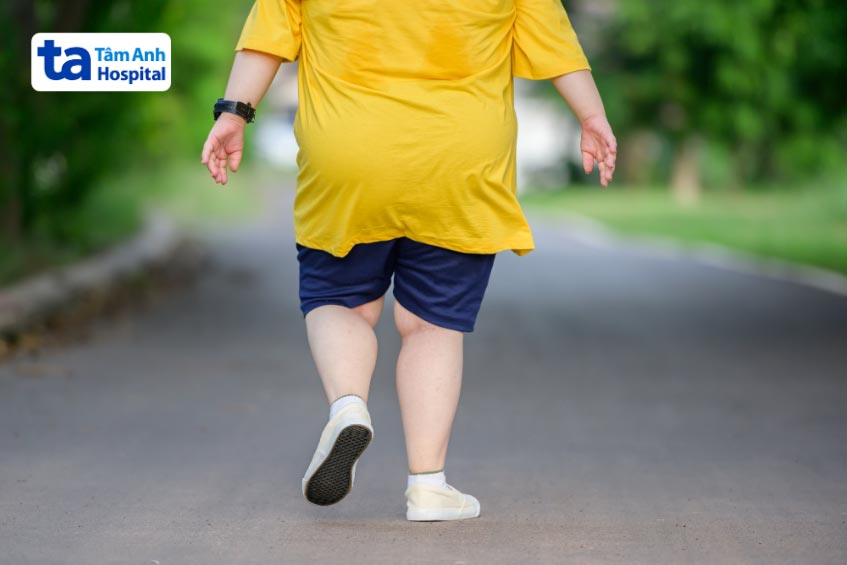 chân bé bị cong hình chữ X khi thừa cân