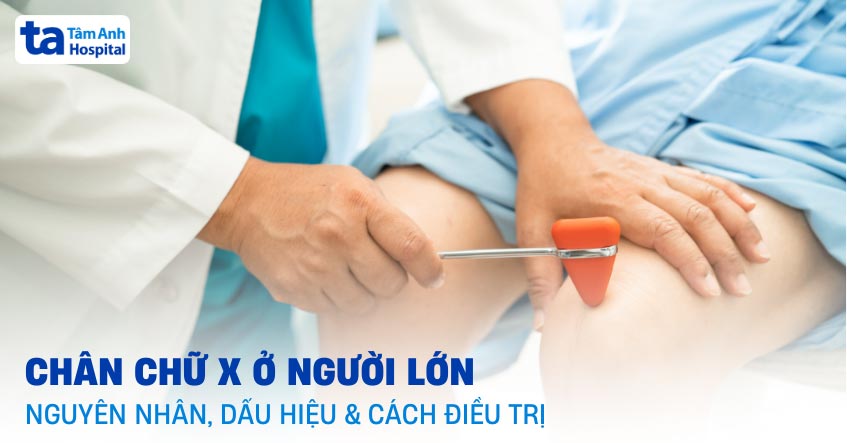 Chân chữ X ở người lớn: Nguyên nhân, dấu hiệu và cách điều trị