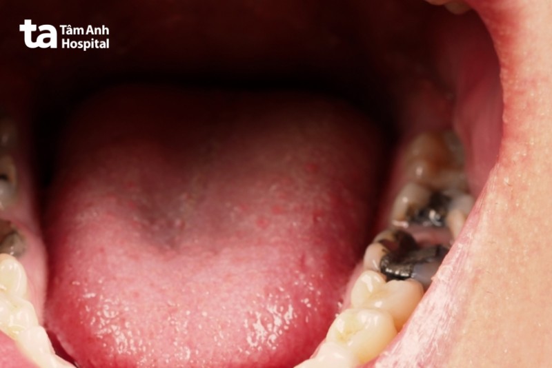 Nên chọn vật liệu hàn trám răng nào?