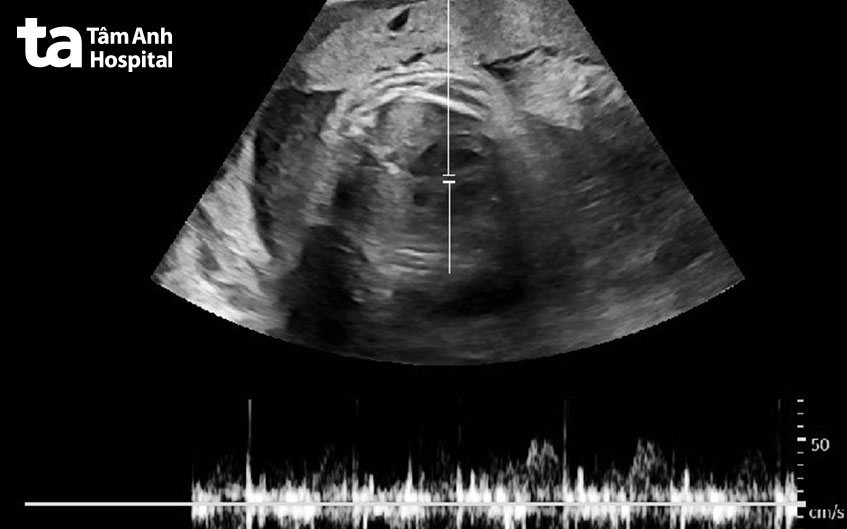 chị liên lần đầu siêu âm bụng