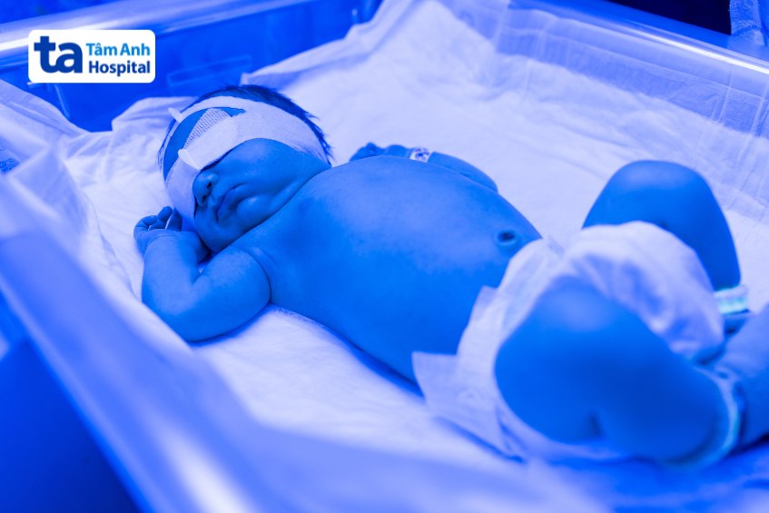 Chiếu đèn trị vàng da cho trẻ sơ sinh