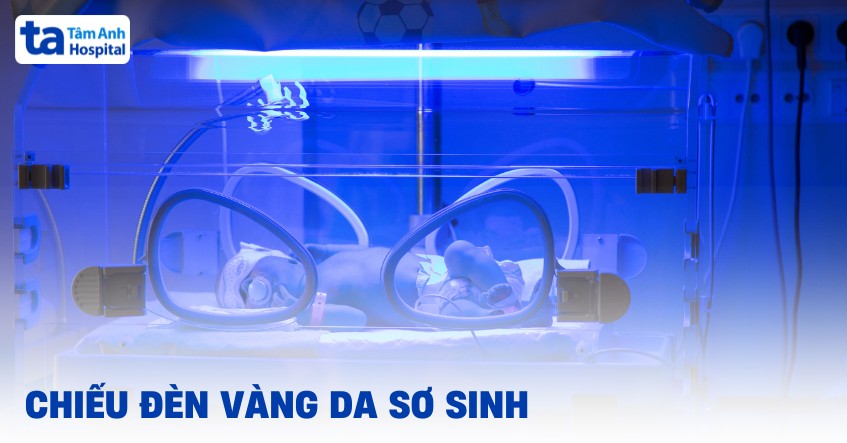 Chiếu đèn vàng da sơ sinh được thực hiện khi nào? Cách thực hiện