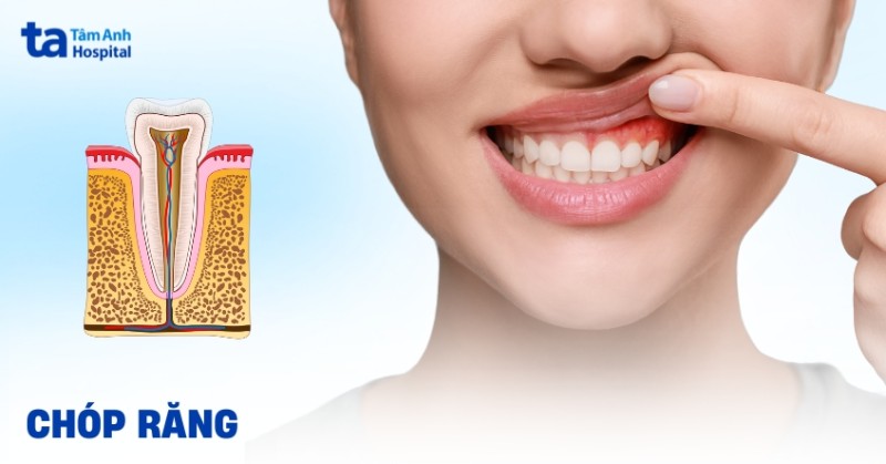 chóp răng