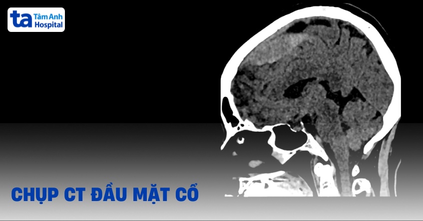 Chụp CT đầu mặt cổ: Khi nào cần, quy trình, có rủi ro không?