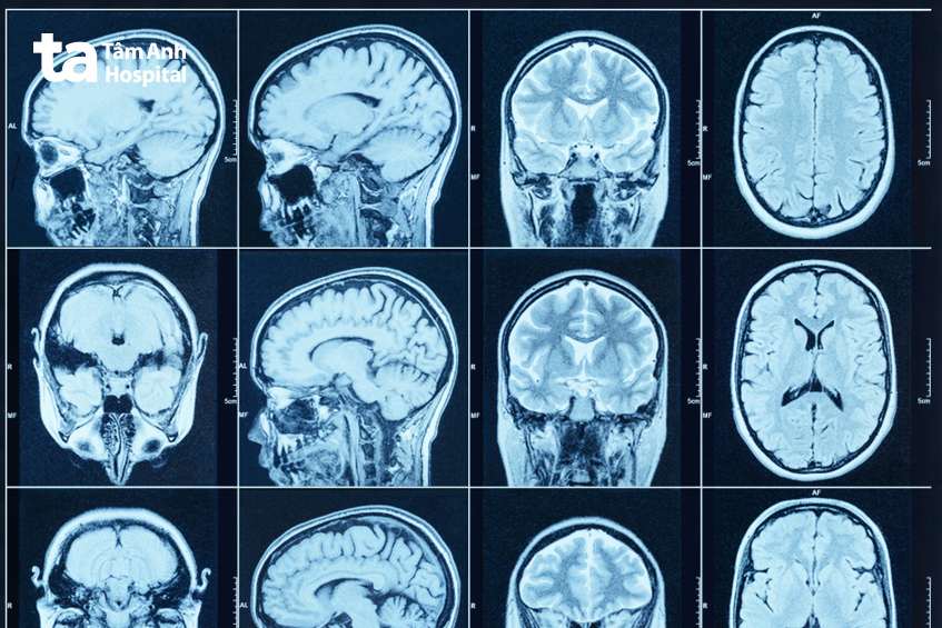 Chụp CT não cho ra hình ảnh sắc nét