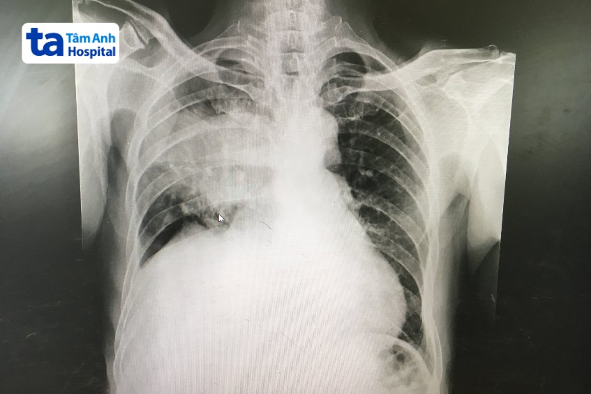Chụp X-quang chẩn đoán viêm phổi thùy