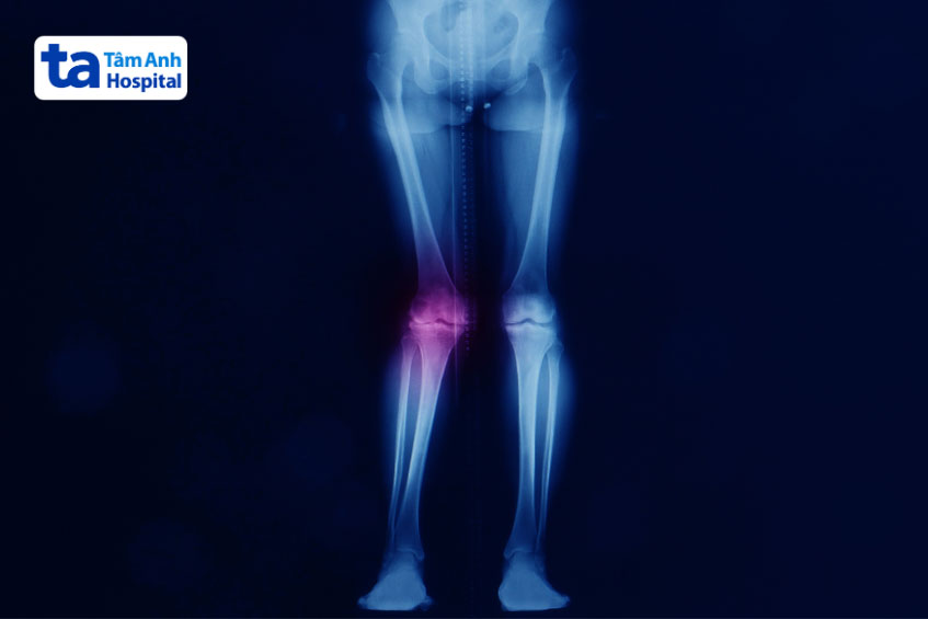 chụp x quang để đánh giá mức độ biến dạng