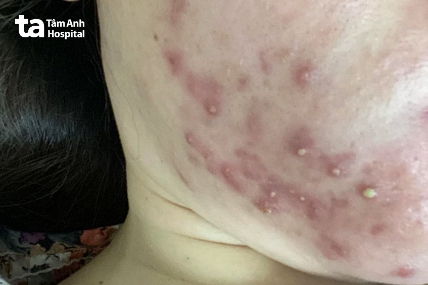 da khách hàng nổi mụn trứng cá sau peel da