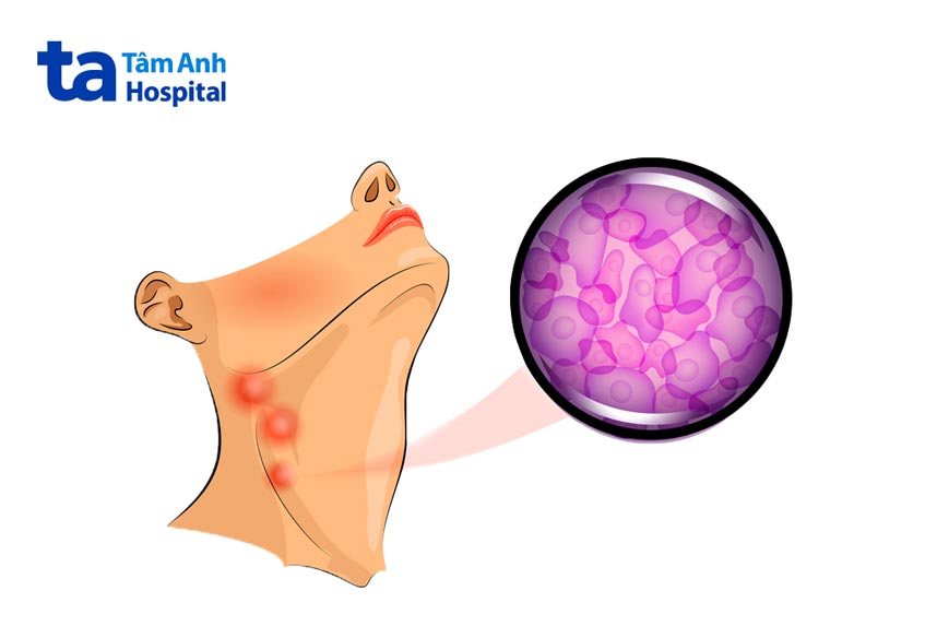 dấu hiệu đang mắc các loại u lympho da khá khác nhau
