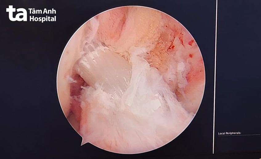 dây chằng được tái tạo thành công