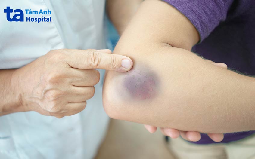dễ bị bầm tím, chảy máu có thể là tác dụng phụ của ghép tế bào gốc