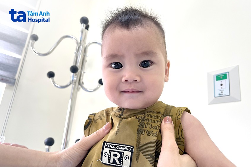 diện đồng tử giãn rộng do glocom biến chứng ở bé trai 10 tháng tuổi