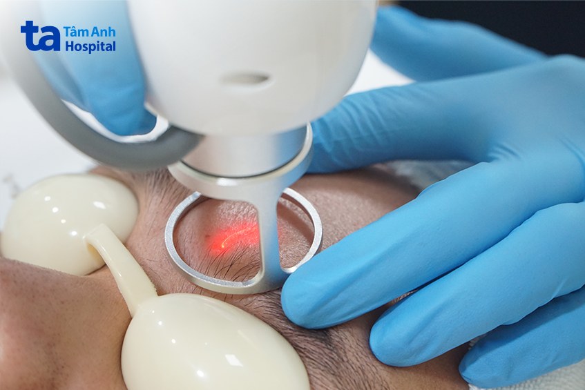 điều trị sẹo rỗ ở trán cho khách hàng nam