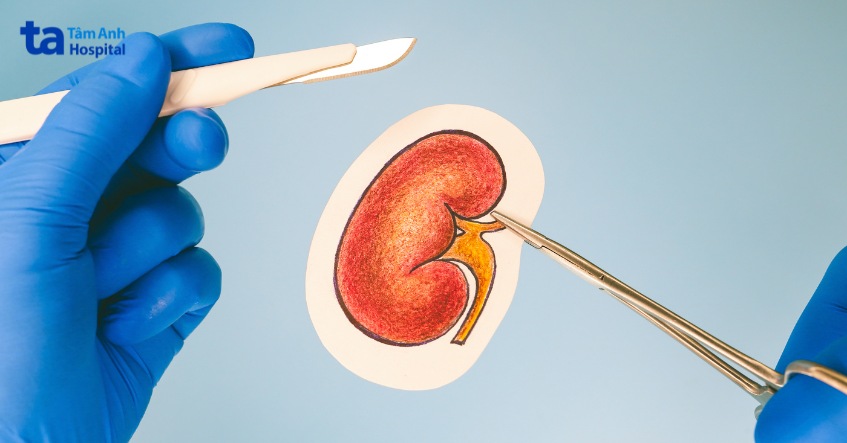 điều trị thận ứ nước độ 3