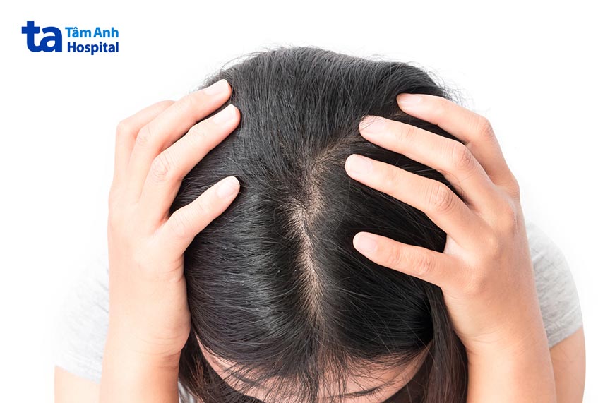 đột biến gen có thể là nguyên nhân mắc bệnh u sao bào lông