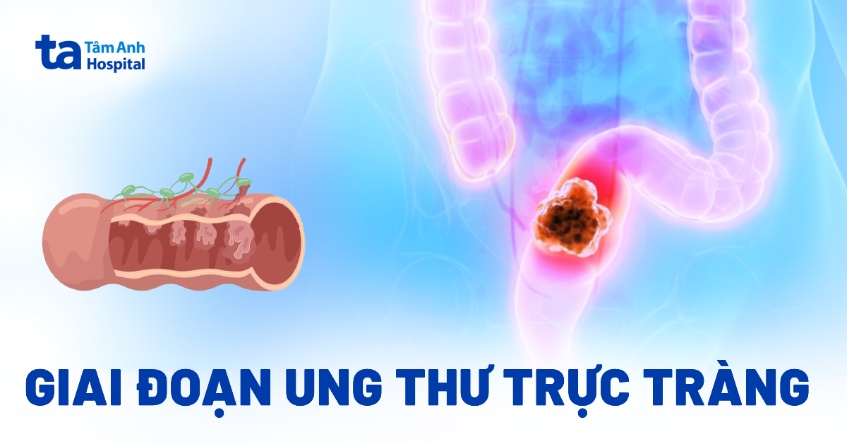 5 giai đoạn ung thư trực tràng: Cách đánh giá và chẩn đoán
