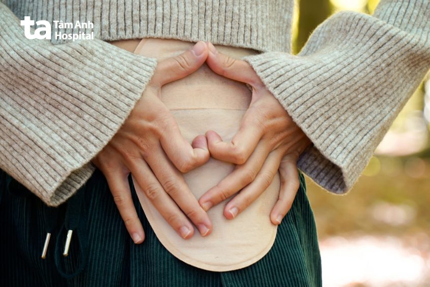 hậu môn nhân tạo điều trị ung thư trực tràng giai đoạn 4