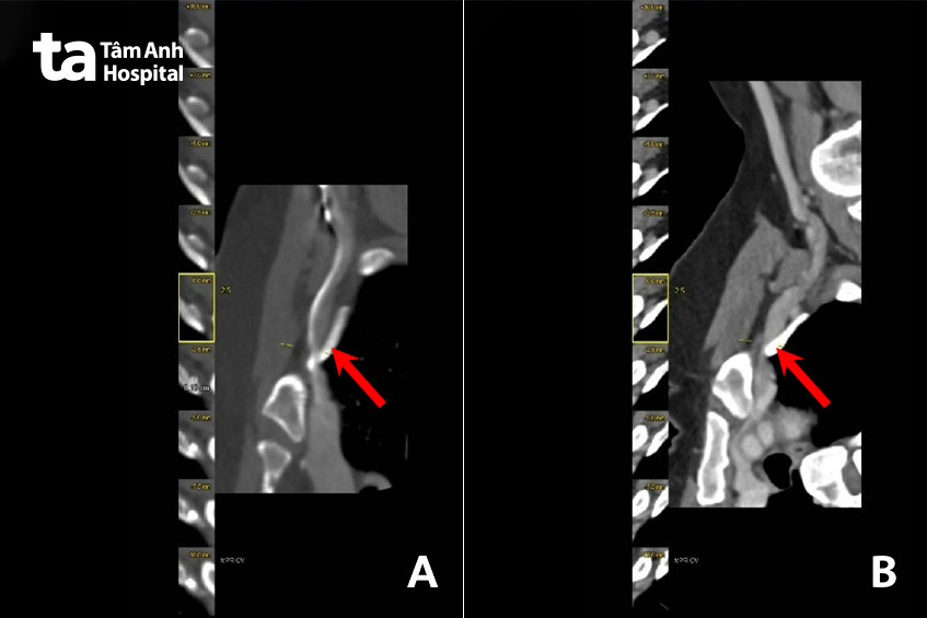 Hình ảnh hẹp nặng tĩnh mạch dưới đòn bên phải (hình A) và trái (hình B), nghi do hội chứng lối thoát lồng ngực
