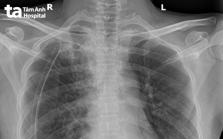 Hình ảnh phổi nở hoàn toàn trên phim chụp X-quang ngay sau mổ