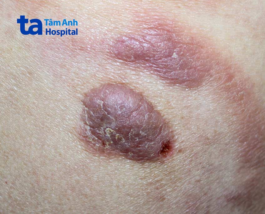 hình ảnh thực tế của mycosis fungoides