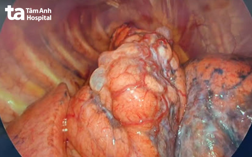 Hình ảnh tổn thương nhiều bóng khí (đã vỡ và chưa vỡ) ở đỉnh phổi phải (hình nhìn qua nội soi lồng ngực)