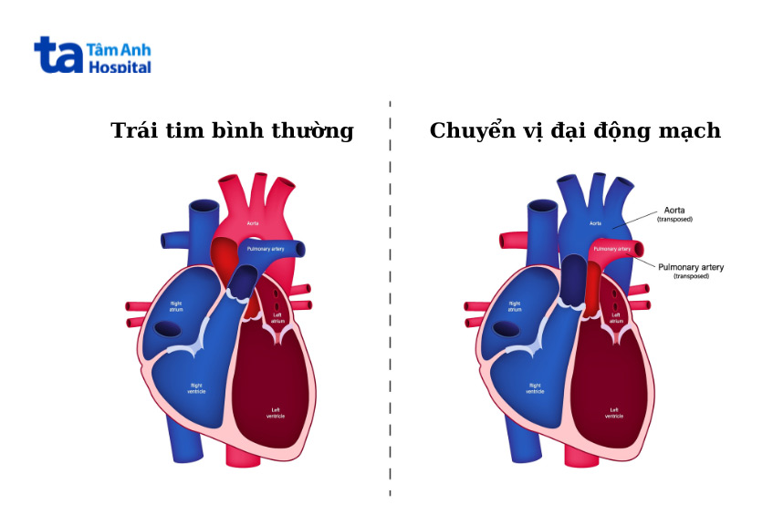 Hình ảnh trái tim bình thường và trái tim bị chuyển vị đại động mạch