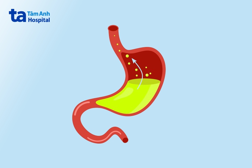 hình ảnh trào ngược họng thanh quản