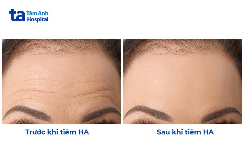 hình ảnh trước và sau khi tiêm ha