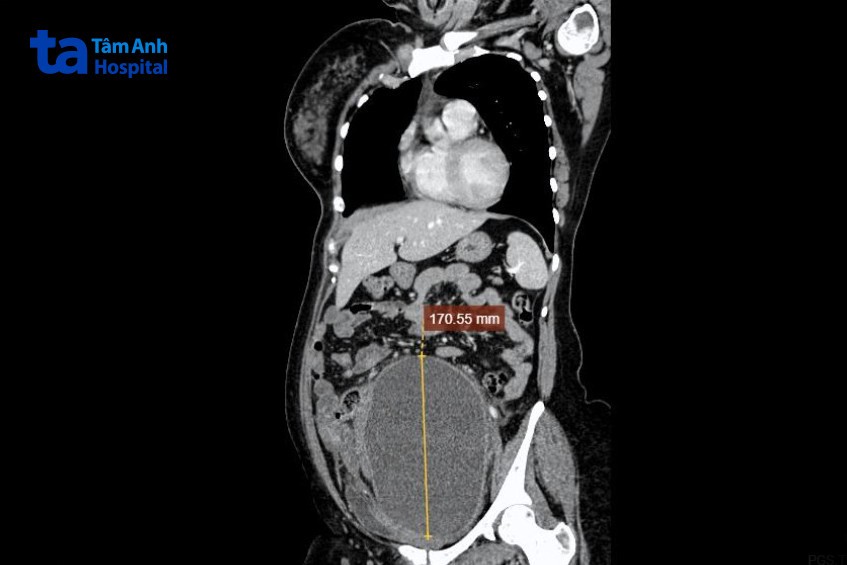 hình ảnh u chèn ép ngũ tạng