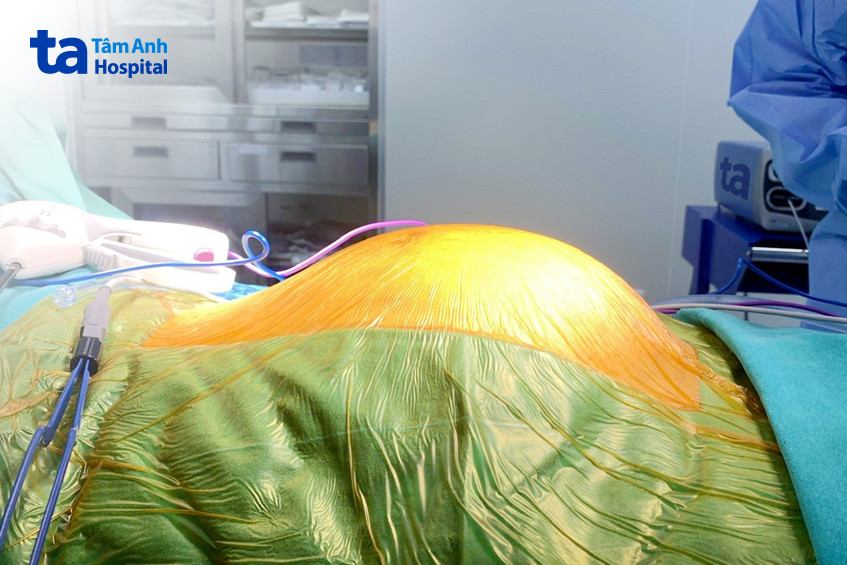 hình ảnh u khổng lồ