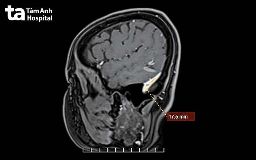 huyết khối tĩnh mạch sọ não